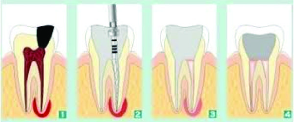 endodonzia serafini endodonzia serafini
