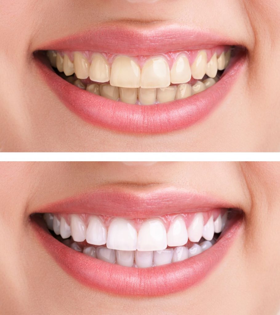 sbiancamento dentale