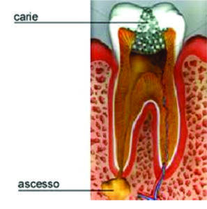 serafini endodonzia