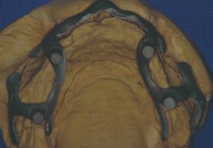 04-dental-subperiost-total-01-300x209 04-dental-subperiost-total-01-300x209