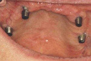 04-dental-subperiost-total-03-300x204 04-dental-subperiost-total-03-300x204